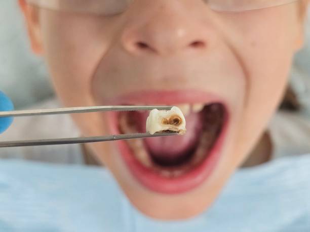 Best Emergency Treatment for Dental Infections or Abscesses in Oolitic, IN